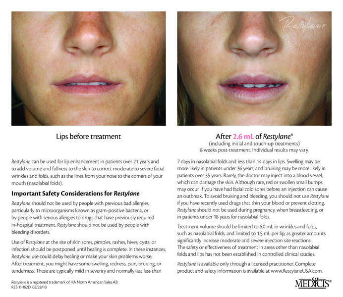 Lip Beforeand After Photos